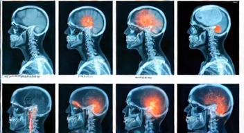 Das sind die Top 7 Schritte beim Knöchelbruch